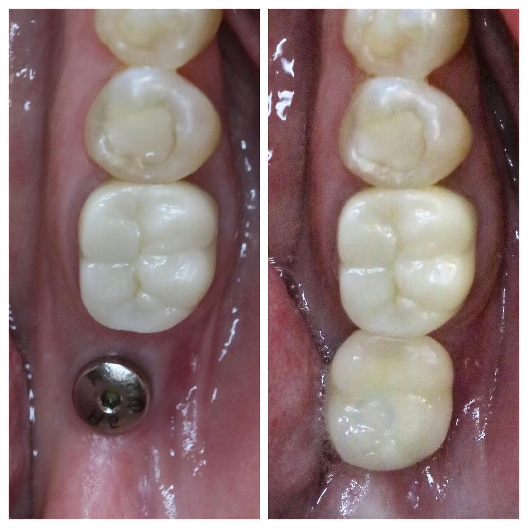Single dental implant restoration before and after