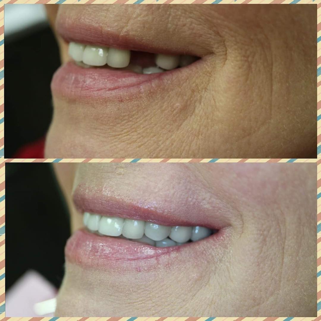 Implant crown restoration before and after