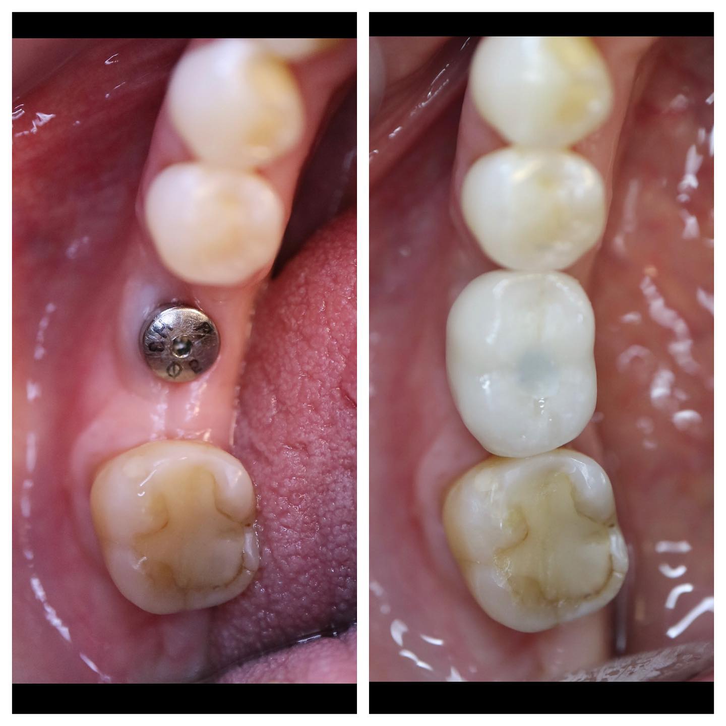 Dental implant before and after replacing a missing tooth