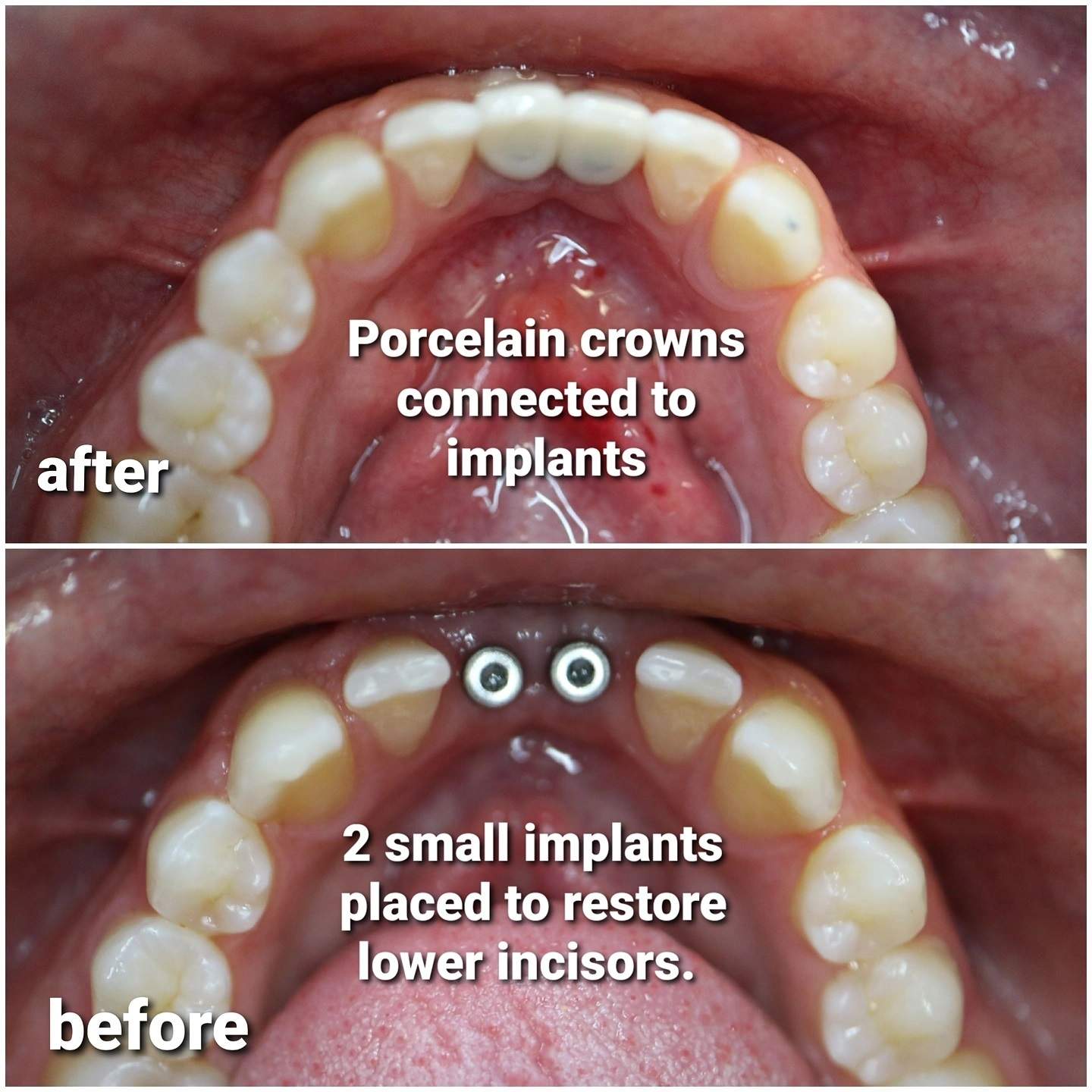 Implant supported crowns before and after