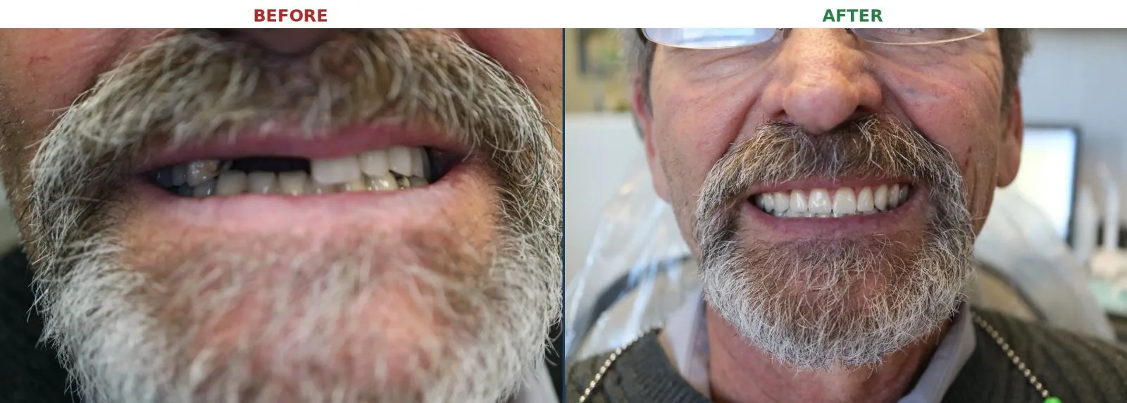 Close up before and after of implant supported denture restoration at Loukas Dentistry Park Ridge IL