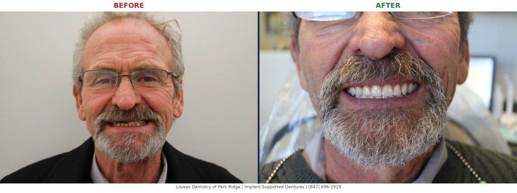 Full face before and after implant-supported denture transformation at Loukas Dentistry Park Ridge IL