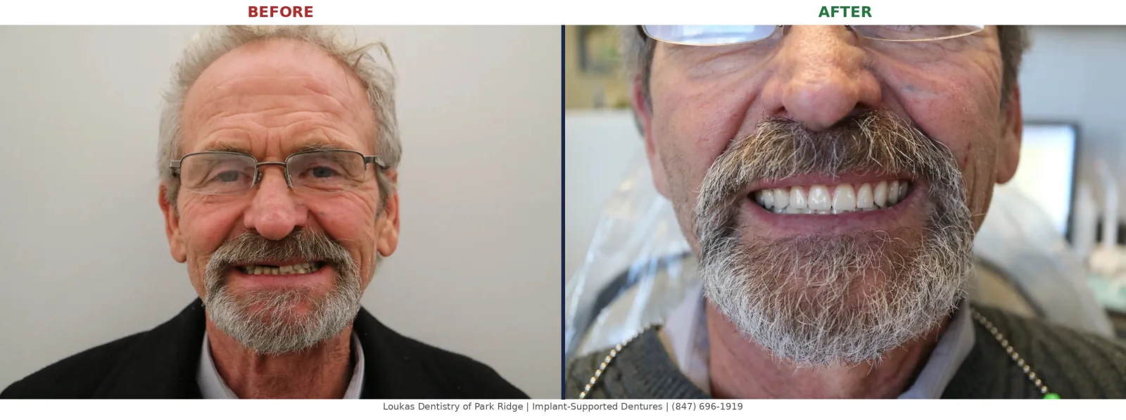 Before and after full face photo of a patient treated with implant-supported dentures at Loukas Dentistry in Park Ridge, IL