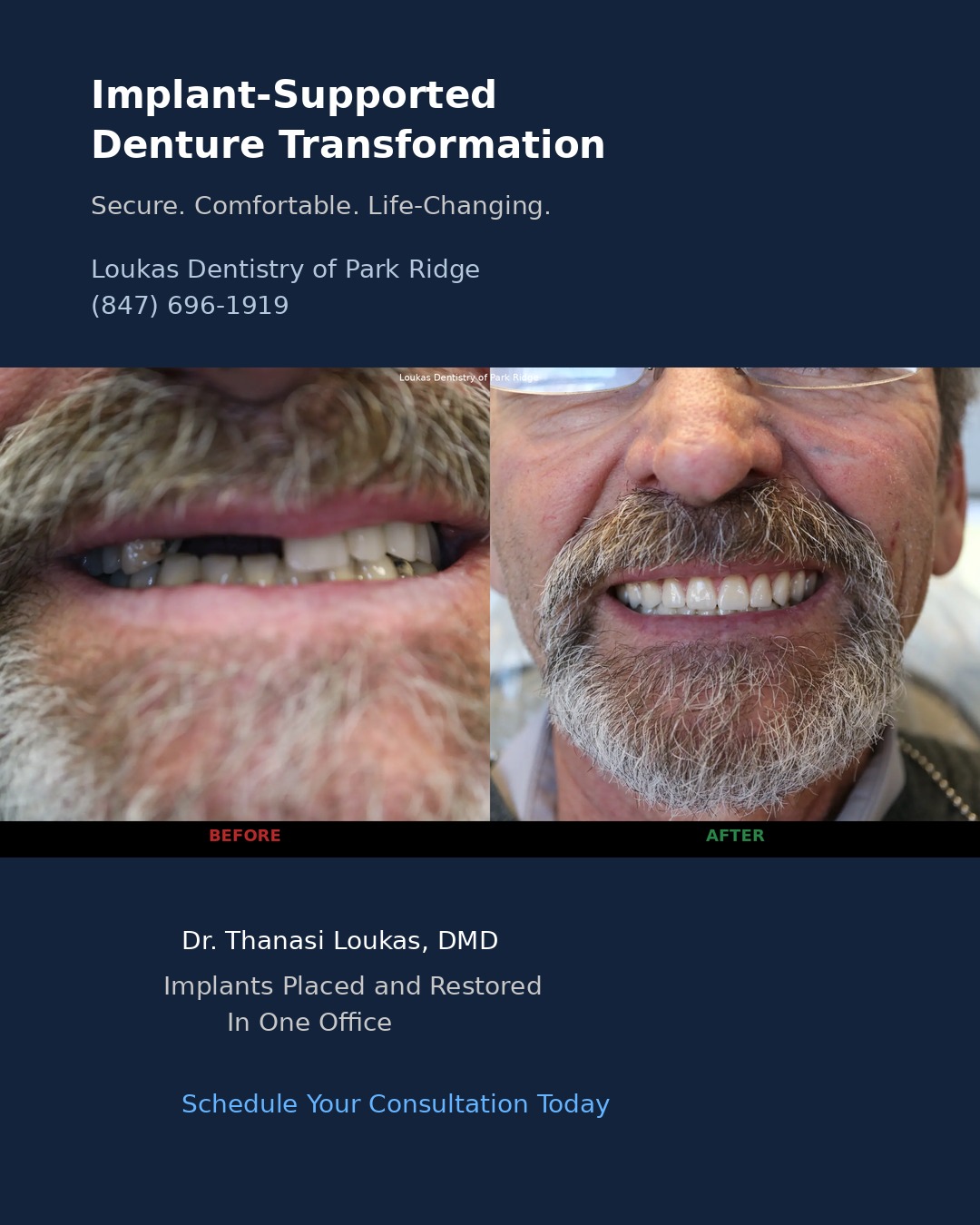 Implant supported denture before and after transformation showing full smile restoration by Dr. Thanasi Loukas in Park Ridge Illinois
