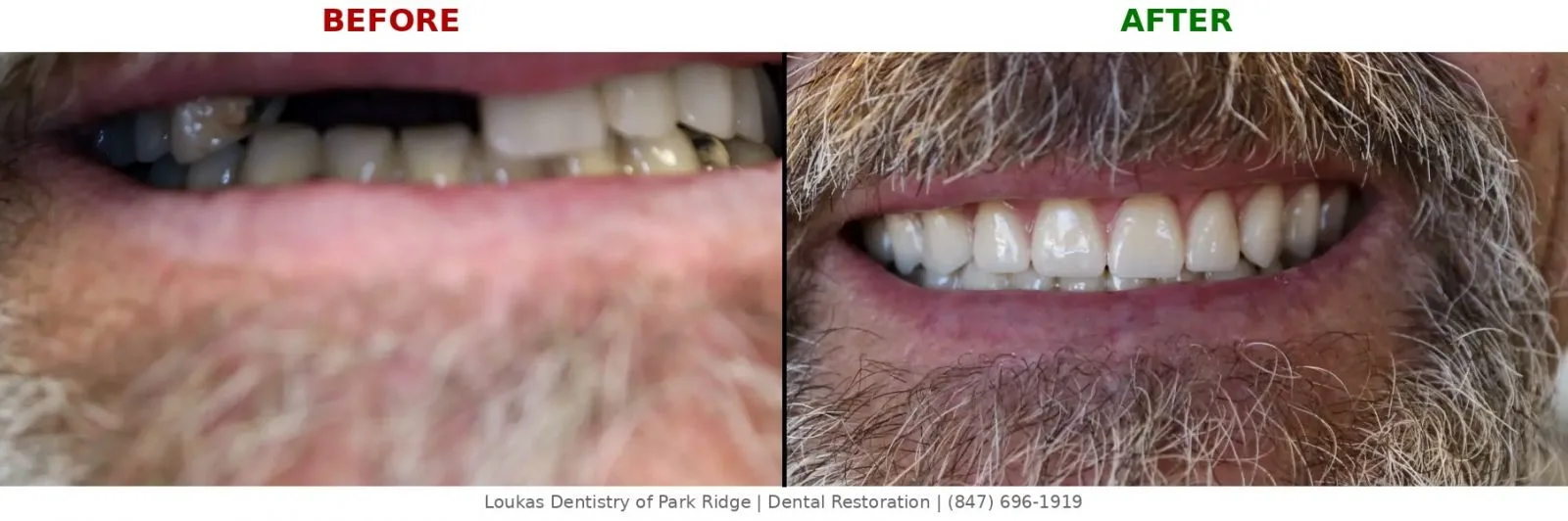 Pixel-perfect close-up before and after dental implant-supported denture showing tooth restoration at Loukas Dentistry Park Ridge