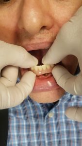 Close-up of the lower gum with a small dental implant visible, held by gloved hands during a dental procedure.