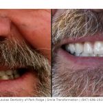 Before and after dental transformation: left shows worn, yellowed teeth; right shows bright, straight teeth in a smile.