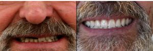 Before and after dental transformation: left shows worn, yellowed teeth; right shows bright, straight teeth in a smile.