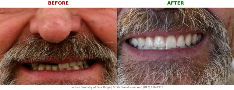 Before and after implant supported dentures at Loukas Dentistry in Park Ridge Illinois