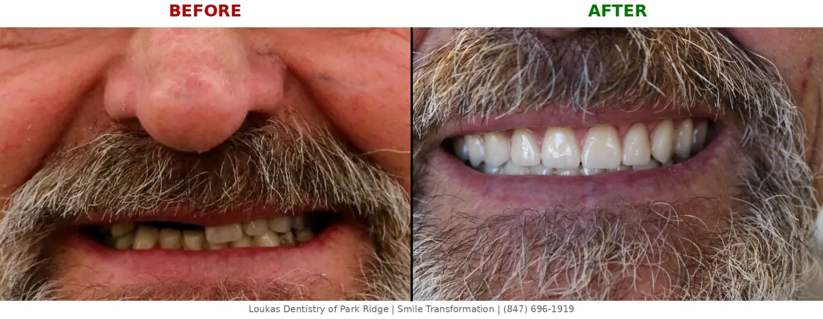 Pixel-perfect full face before and after implant-supported denture transformation at Loukas Dentistry Park Ridge IL