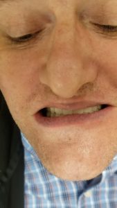 Close-up of a man's face with eyes closed and teeth showing, as if grimacing or in discomfort.