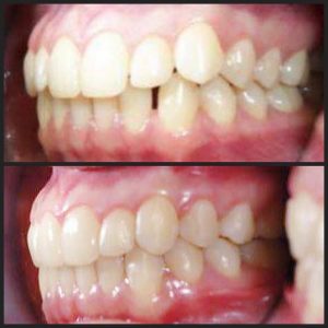 Invisalign Final Result