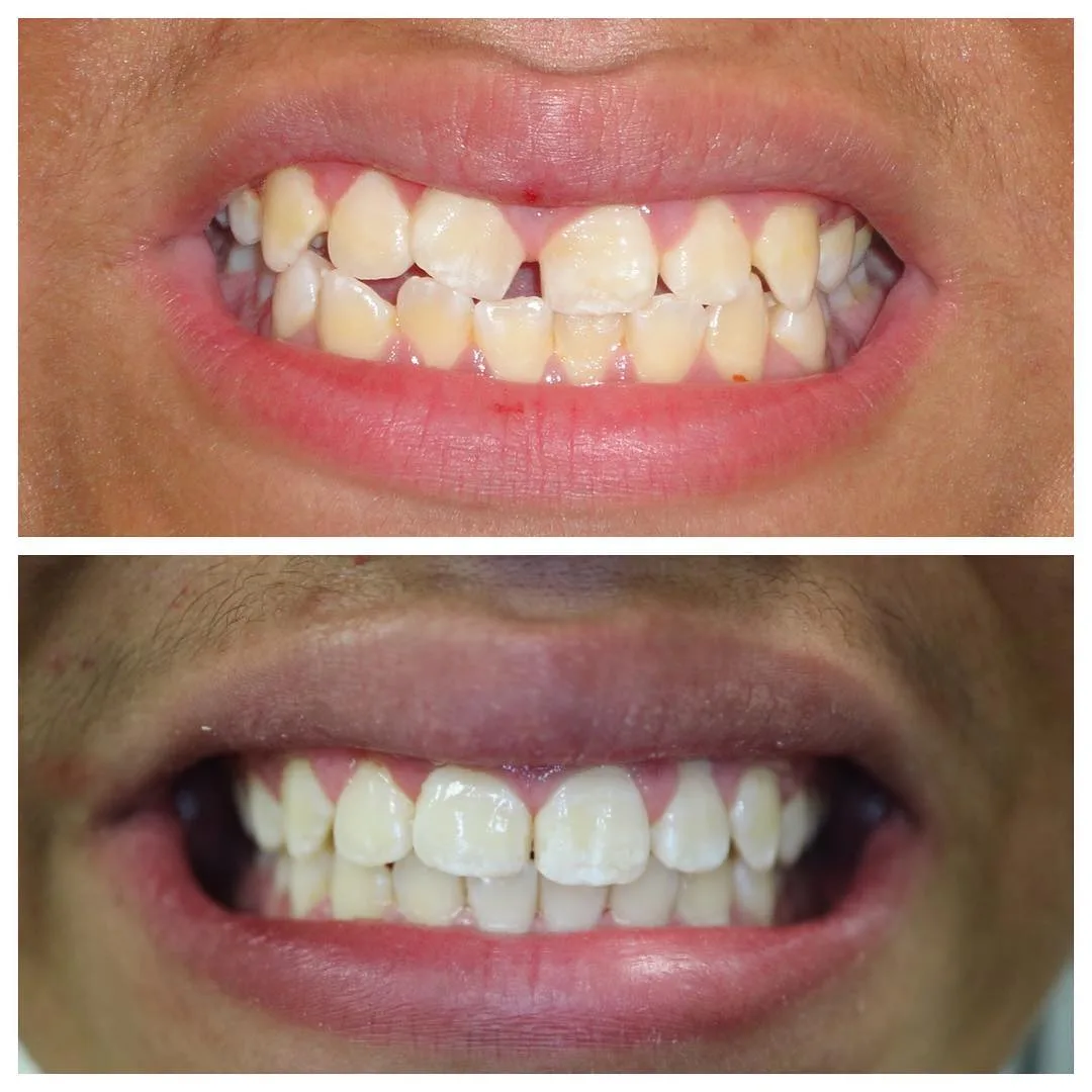 Invisalign Straight Smile Result Loukas Dentistry of Park Ridge Invisalign before and after in Park Ridge, IL - spacing closed with clear aligners