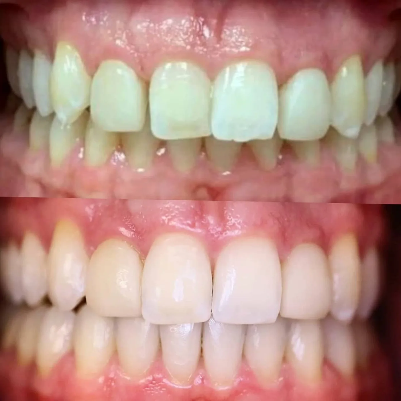 Invisalign Before and After