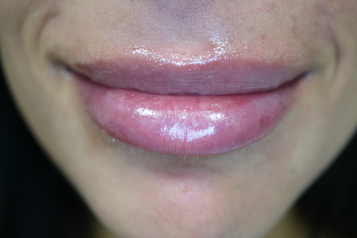 Lip filler result at Loukas Dentistry