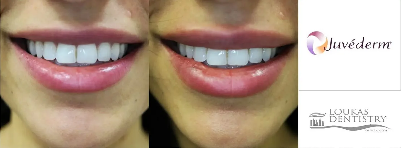 Juvรฉderm lip filler before and after result at Loukas Dentistry in Park Ridge