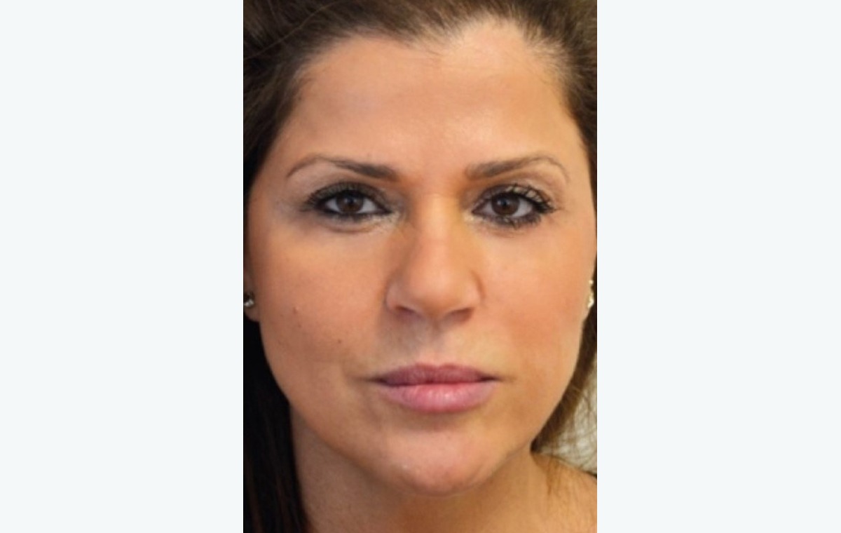Dr Thanasi Loukas providing Botox treatment at Loukas Dentistry in Park Ridge