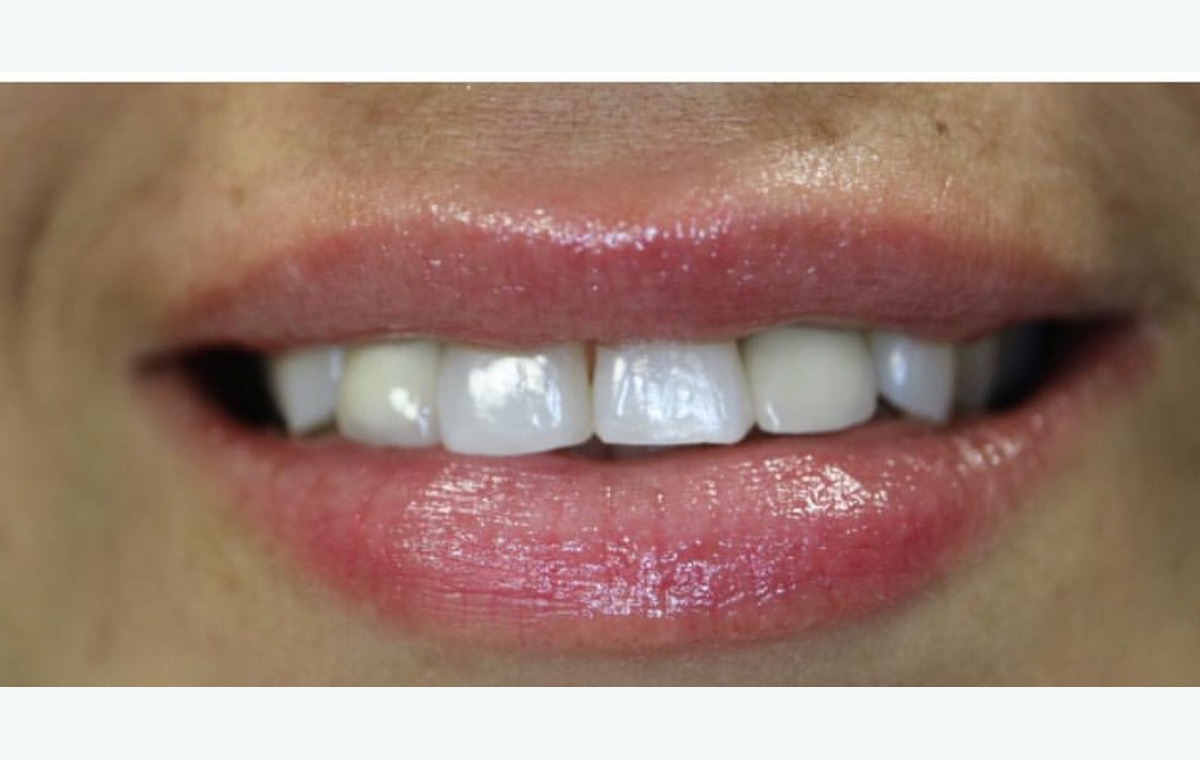 Dental implants Park Ridge smile transformation