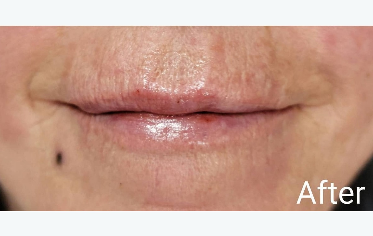 Lip filler Park Ridge facial aesthetic treatment result
