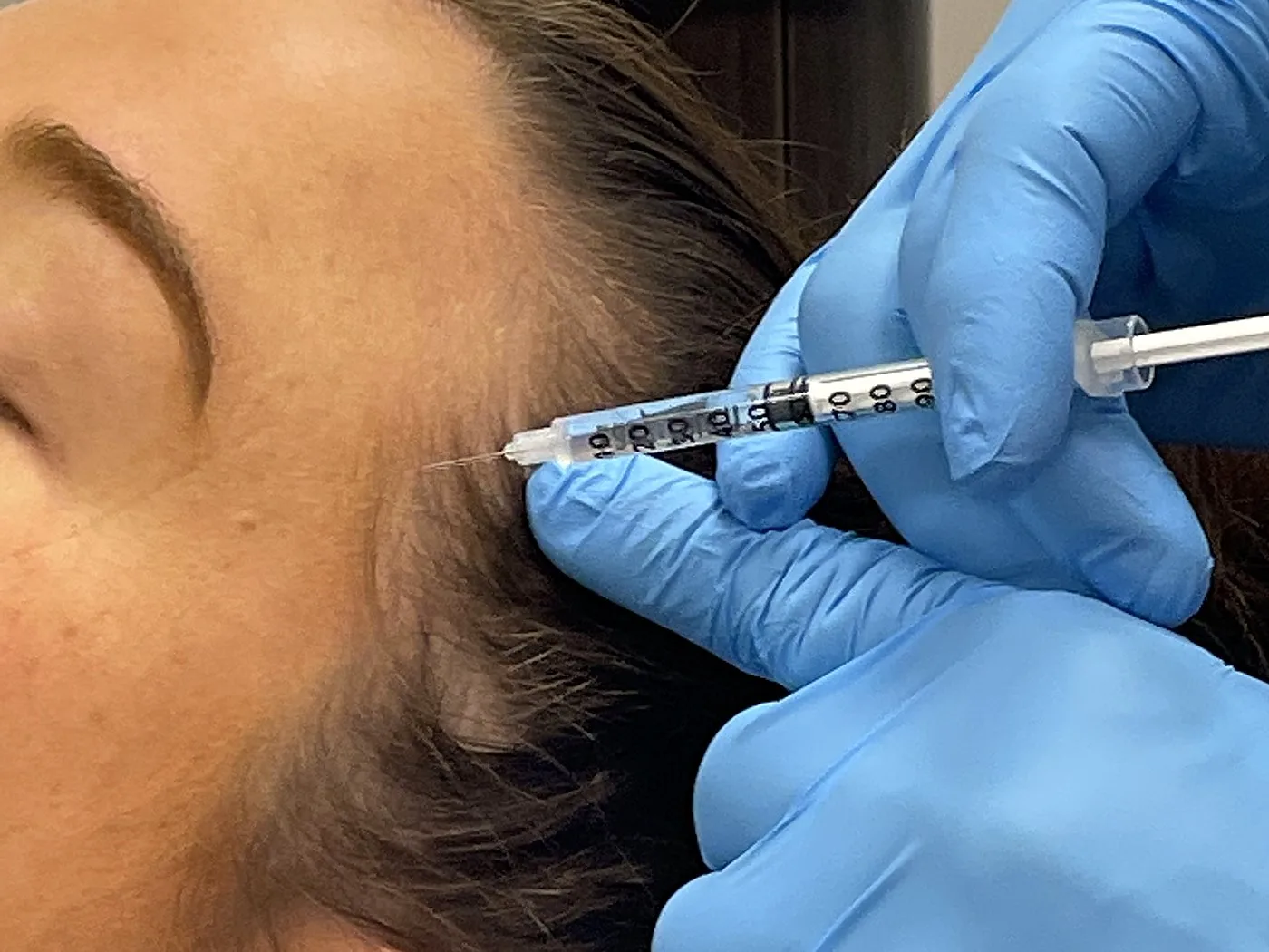 Botox migraine injection point map at Loukas Dentistry in Park Ridge IL