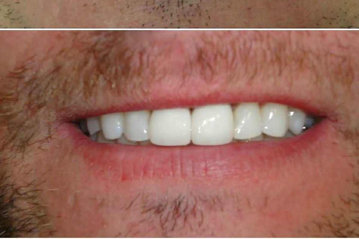 Dental crowns Park Ridge restorative dentistry result