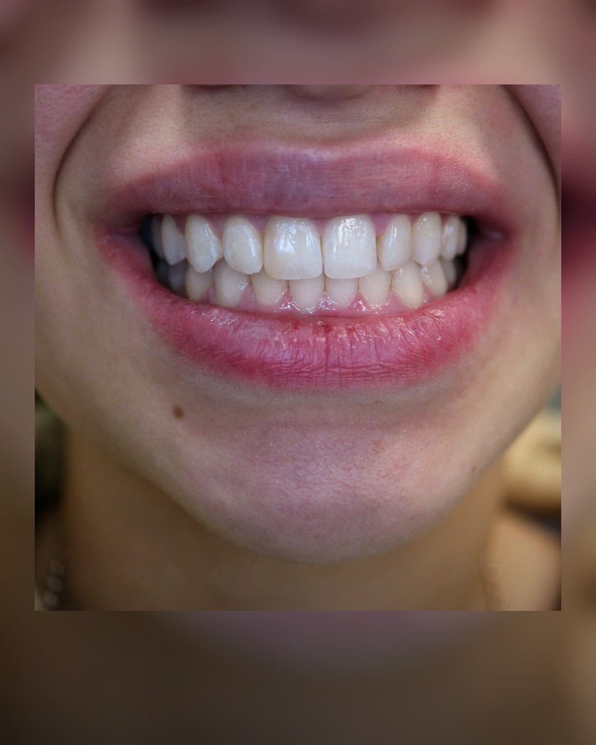 Invisalign smile results at Loukas Dentistry