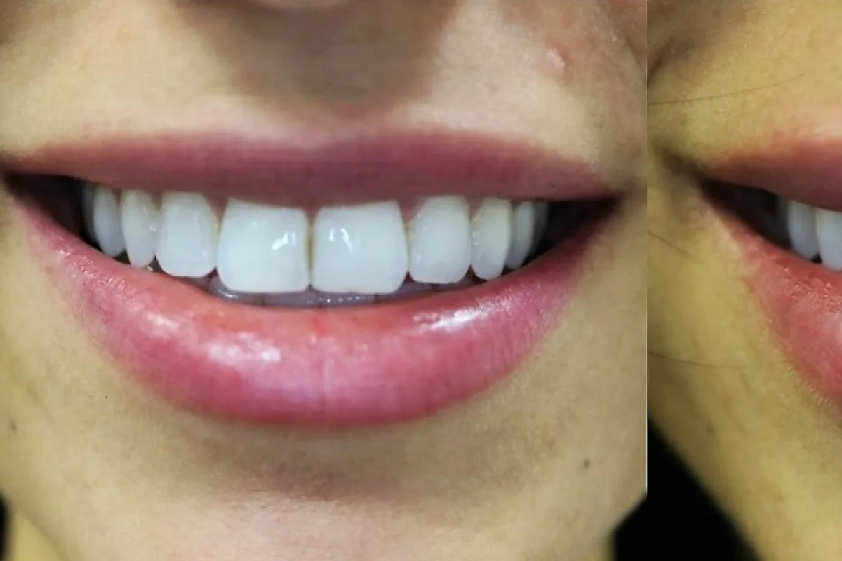 Lip fillers result at Loukas Dentistry in Park Ridge
