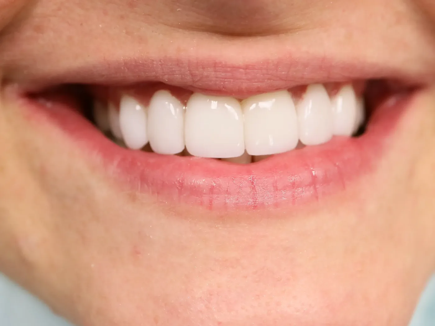 Cosmetic dentistry and veneers smile result in Park Ridge