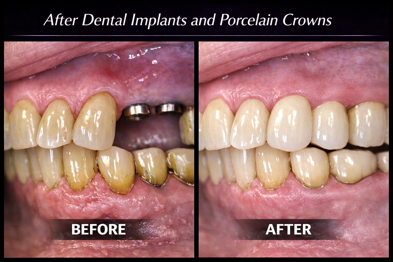 Dental implants before and after porcelain crowns result