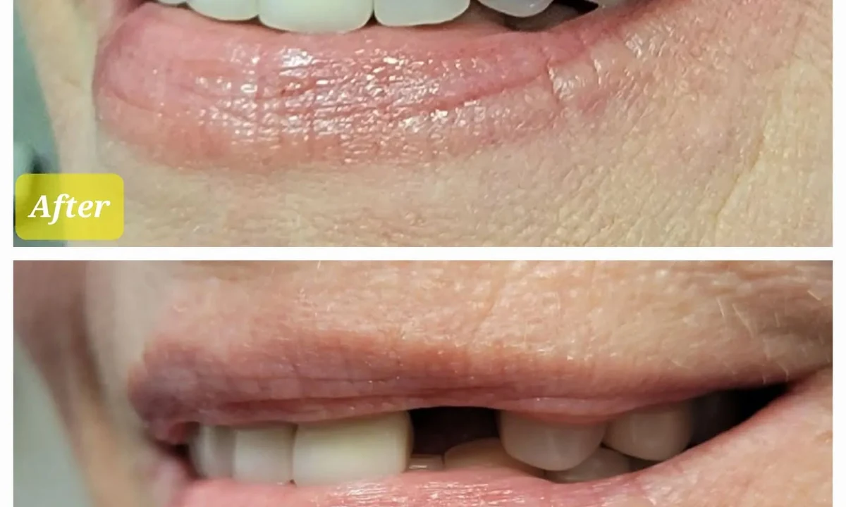 Dental implant tooth replacement result at Loukas Dentistry in Park Ridge IL