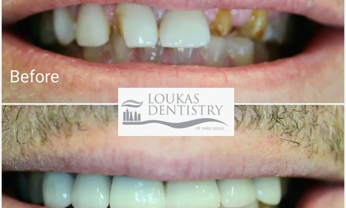 Porcelain dental crowns result at Loukas Dentistry in Park Ridge IL