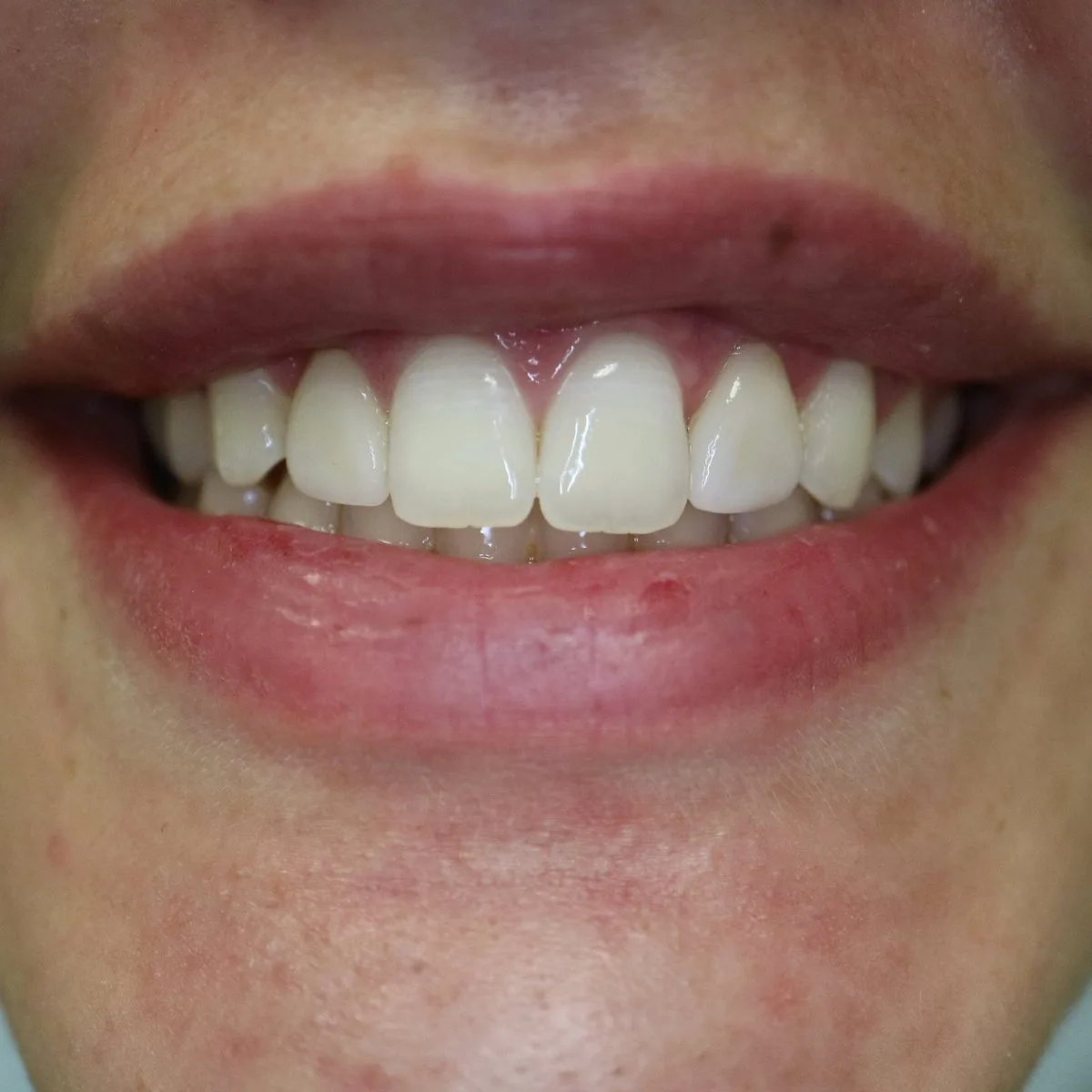 Porcelain veneers smile result at Loukas Dentistry in Park Ridge