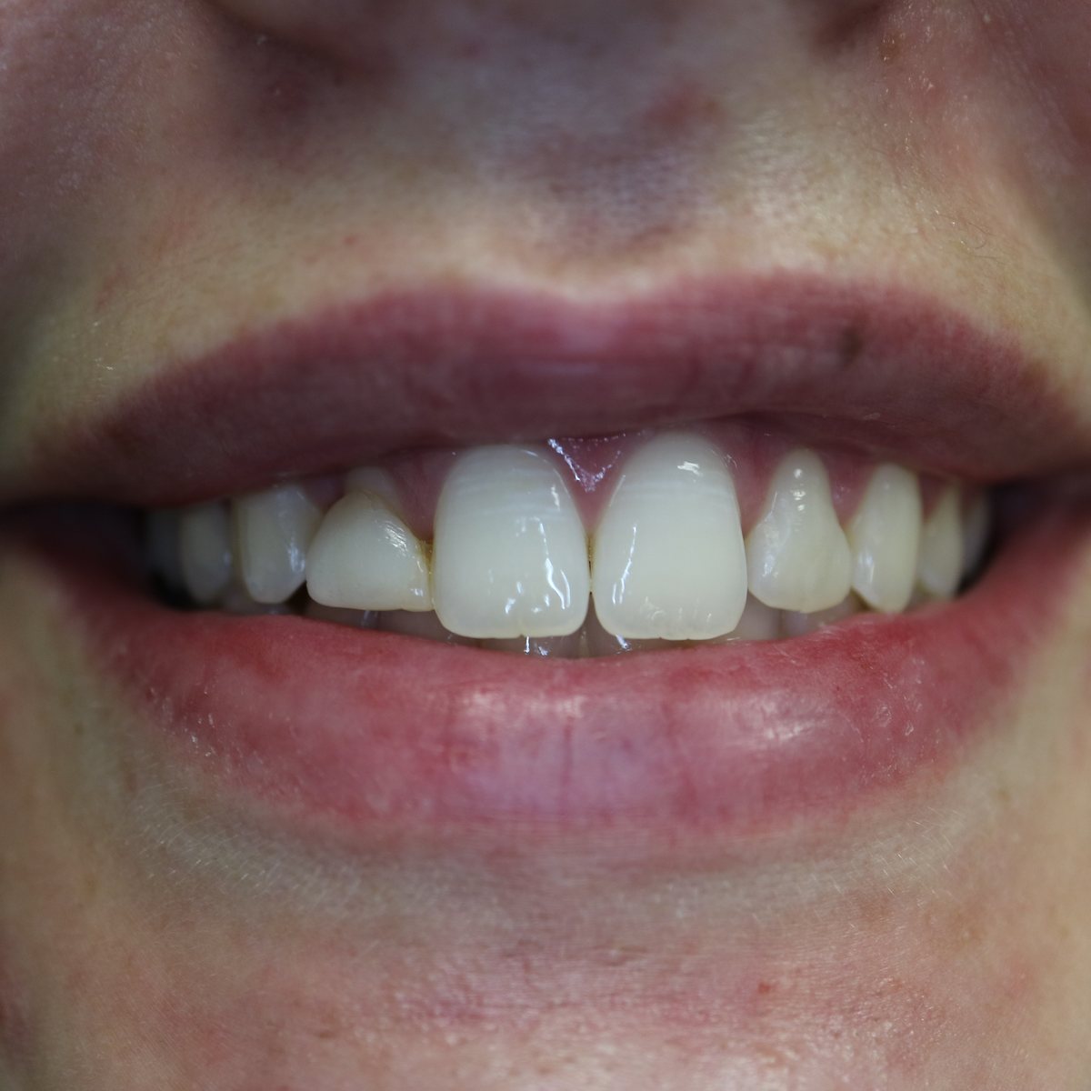 Before photo for four porcelain veneers case at Loukas Dentistry in Park Ridge IL