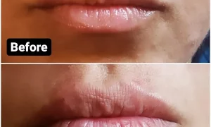 Facial aesthetics result for Kybella and cosmetic treatments at Loukas Dentistry in Park Ridge IL