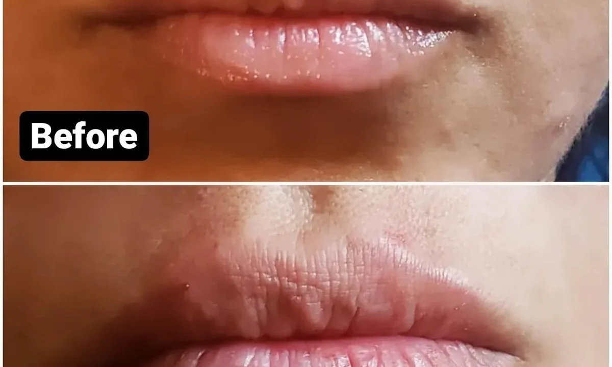 Facial aesthetics result for Kybella and cosmetic treatments at Loukas Dentistry in Park Ridge IL
