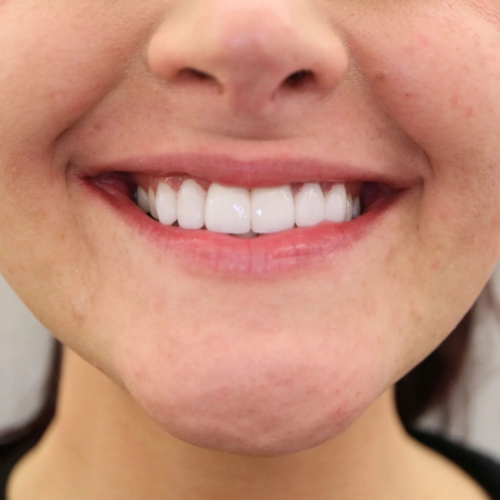 Porcelain veneers smile transformation at Loukas Dentistry of Park Ridge IL