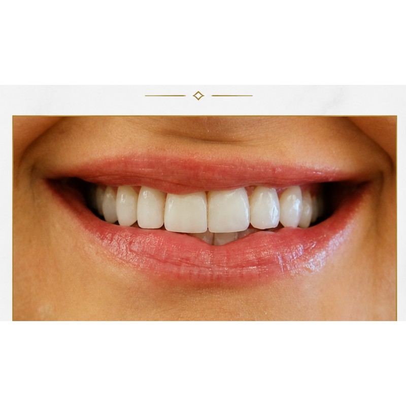Porcelain veneers Park Ridge cosmetic dentistry result