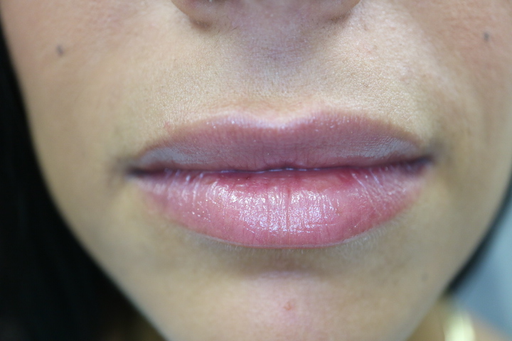 Park Ridge Juvederm Lip Filler Result, Natural Lip Enhancement Juvederm lip filler result at Loukas Dentistry in Park Ridge IL