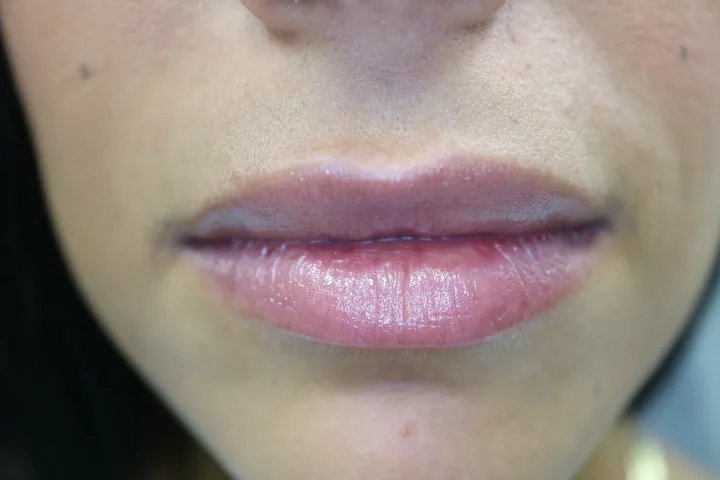 Juvederm lip filler result at Loukas Dentistry in Park Ridge IL