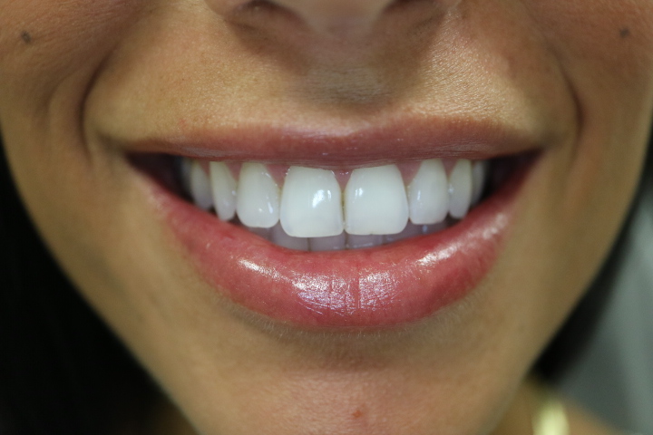 Natural Juvederm lip filler result at Loukas Dentistry Park Ridge IL