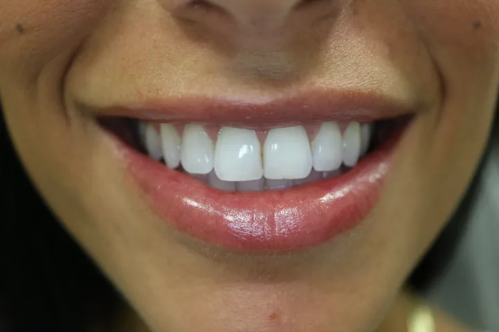 Lip Fillers