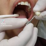Close-up of a patient’s open mouth during a dental implant procedure, with gloved hands and dental instruments nearby.