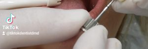 Close-up of a patient’s open mouth during a dental implant procedure, with gloved hands and dental instruments nearby.