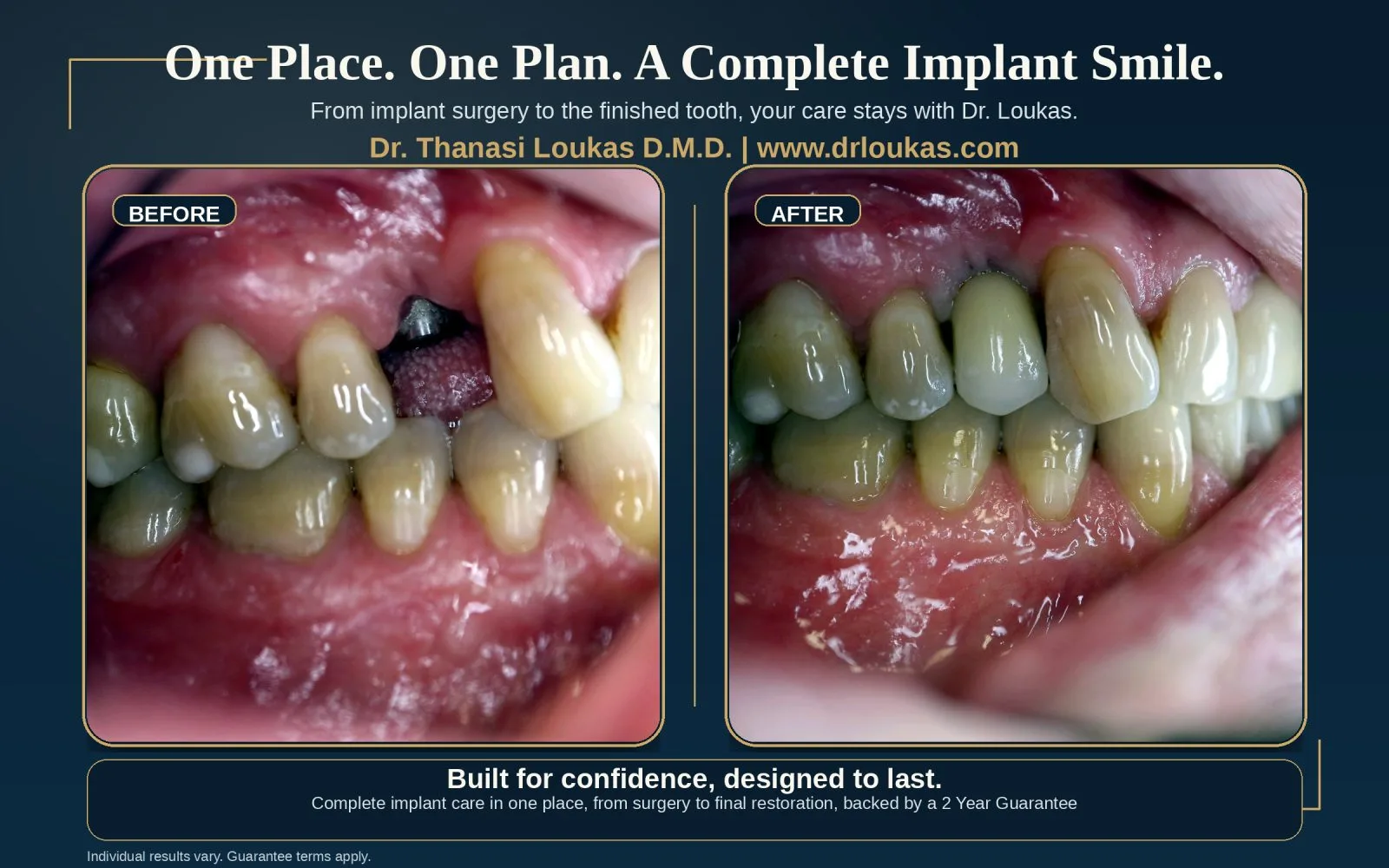 Before and after single tooth dental implant case completed from surgery to final restoration by Dr Loukas