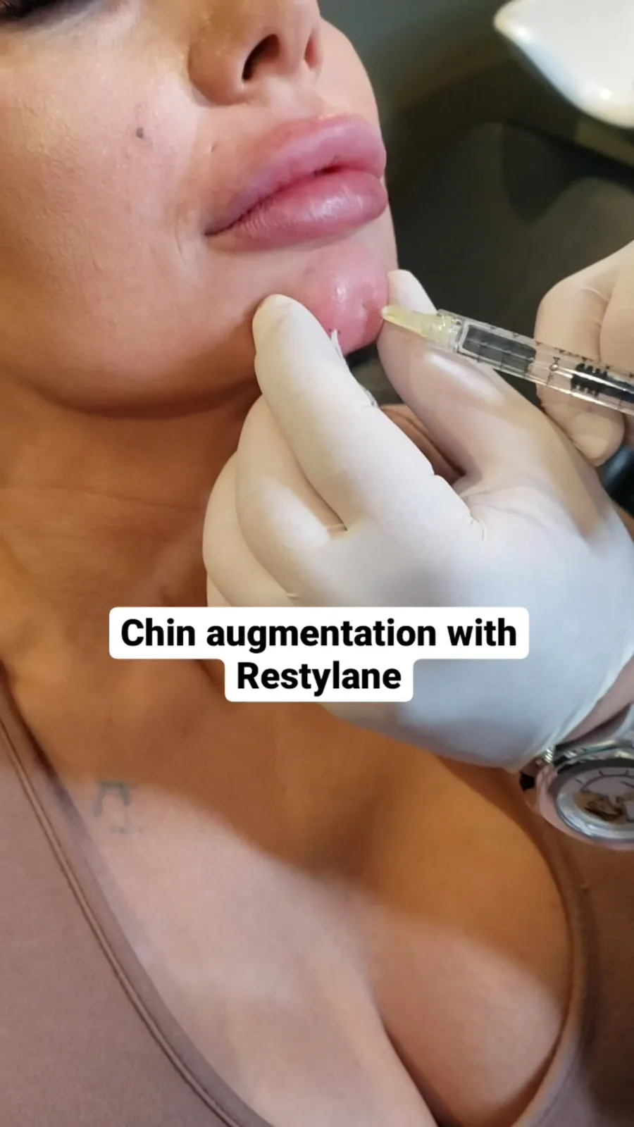 Chin Filler video