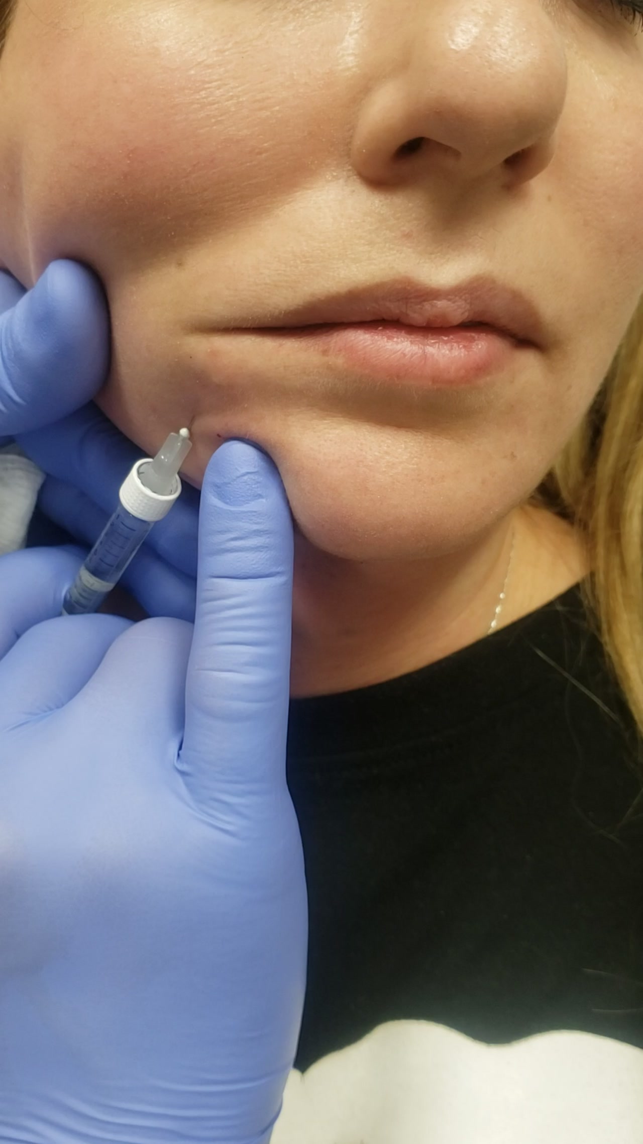 Dermal Filler Treatment video