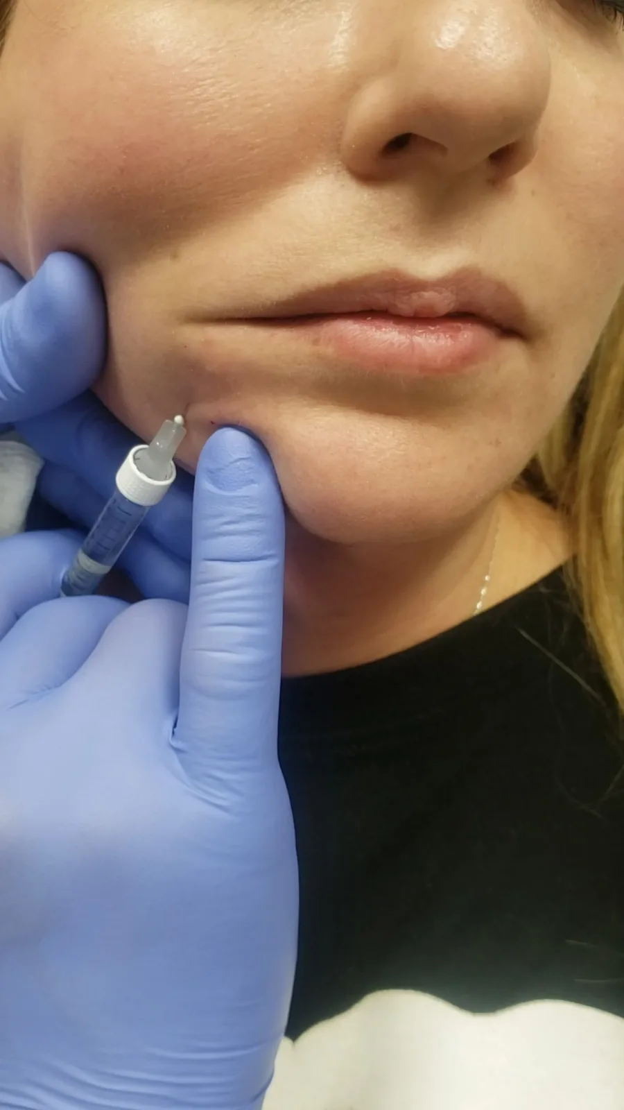 Dermal fillers treatment at Loukas Dentistry in Park Ridge