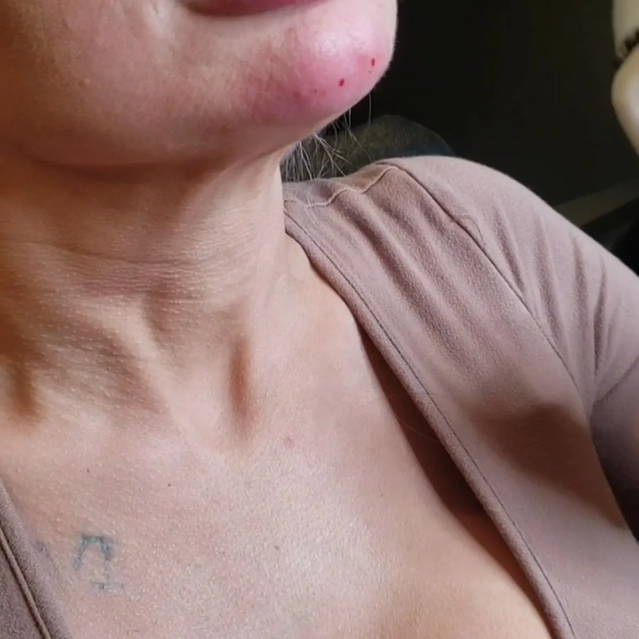 Kybella double chin treatment result at Loukas Dentistry in Park Ridge IL