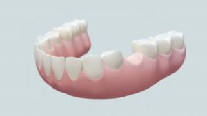 Single tooth implant and crown video thumbnail, Loukas Dentistry Park Ridge IL