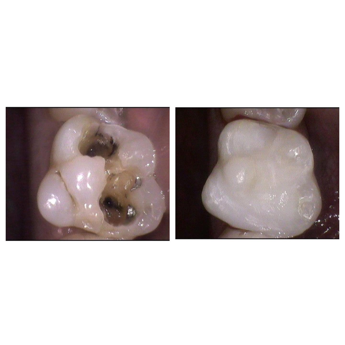 Composite filling restoration
